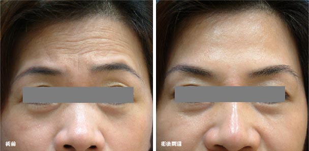 如何去除抬头纹？