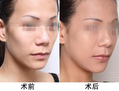 丰苹果肌的方法