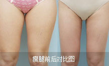 瘦腿对比图